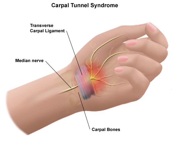 Carpal Tunnel Syndrome Explanation